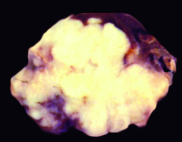 Pathology Outlines Metastases 